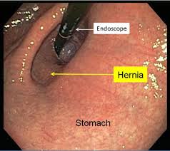 mide fıtığı belirtileri